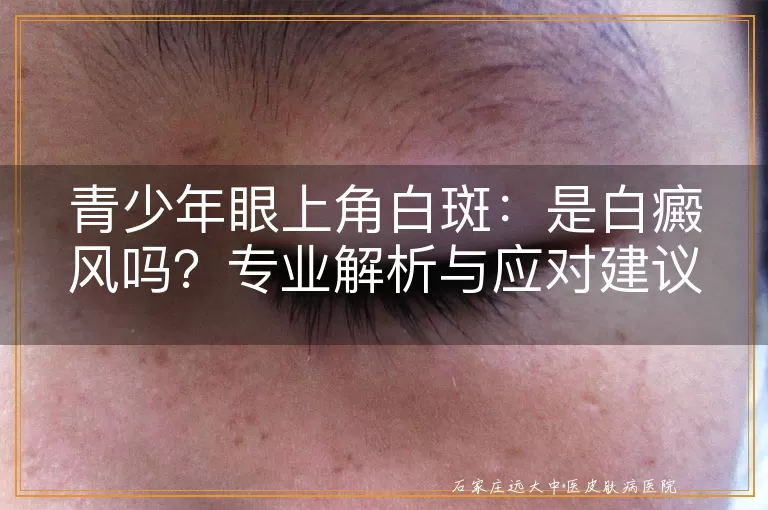 青少年眼上角白斑:是白癜风吗?专业解析与应对建议