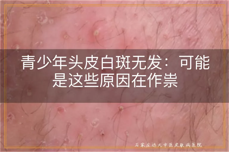 青少年头皮白斑无发:可能是这些原因在作祟