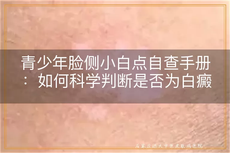青少年脸侧小白点自查手册：如何科学判断是否为白癜风
