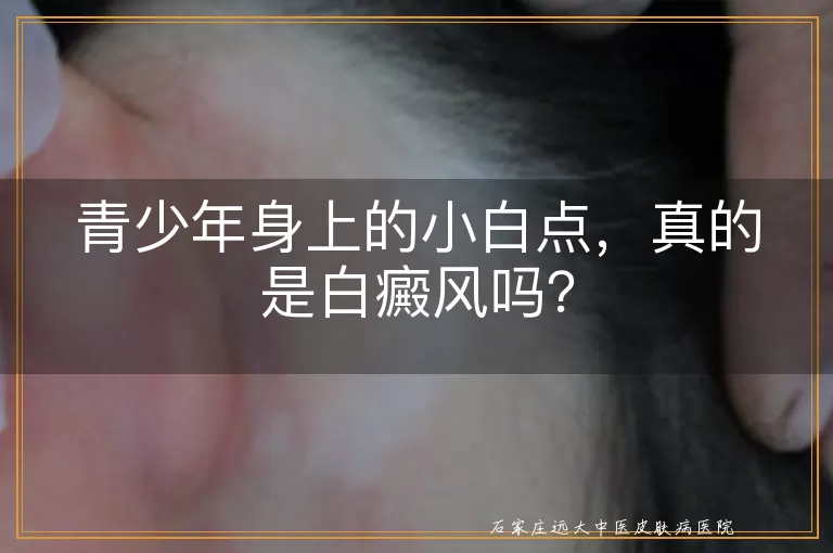 青少年身上的小白点，真的是白癜风吗？