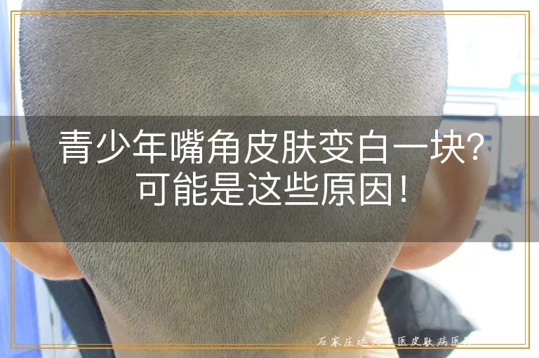 青少年嘴角皮肤变白一块？可能是这些原因！