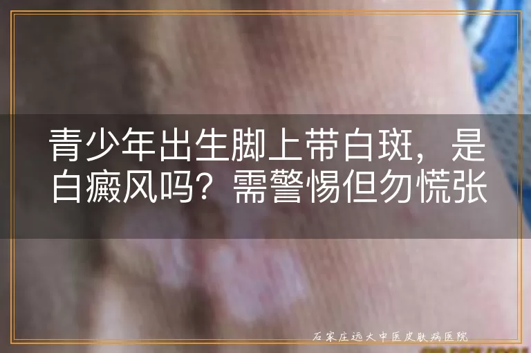 青少年出生脚上带白斑，是白癜风吗？需警惕但勿慌张