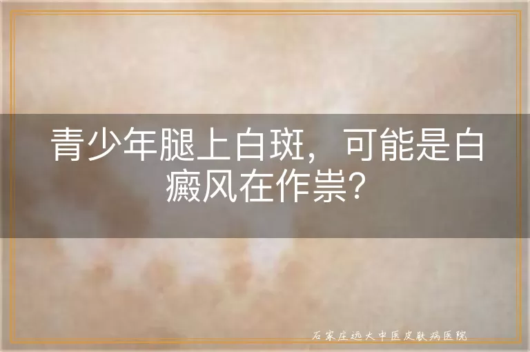 青少年腿上白斑，可能是白癜风在作祟？