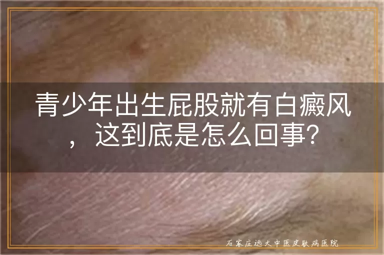 青少年出生屁股就有白癜风，这到底是怎么回事？