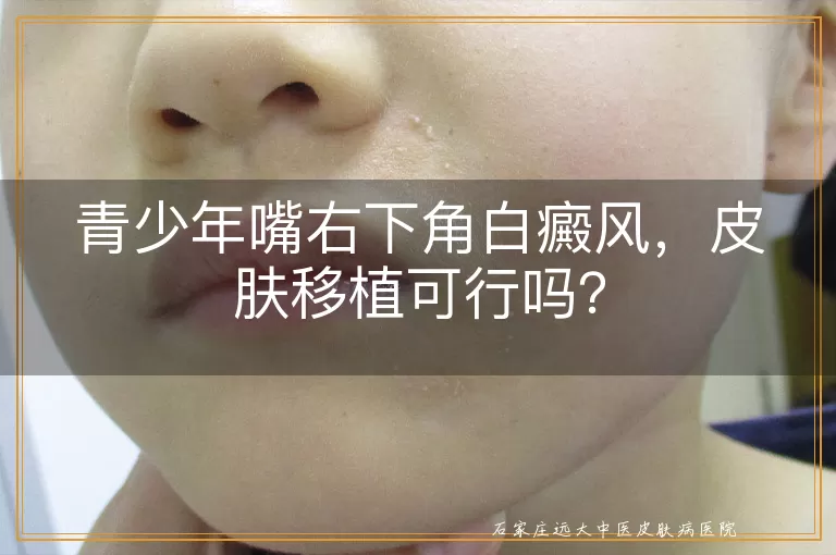 青少年嘴右下角白癜风，皮肤移植可行吗？