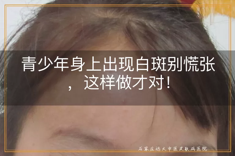 青少年身上出现白斑别慌张，这样做才对！