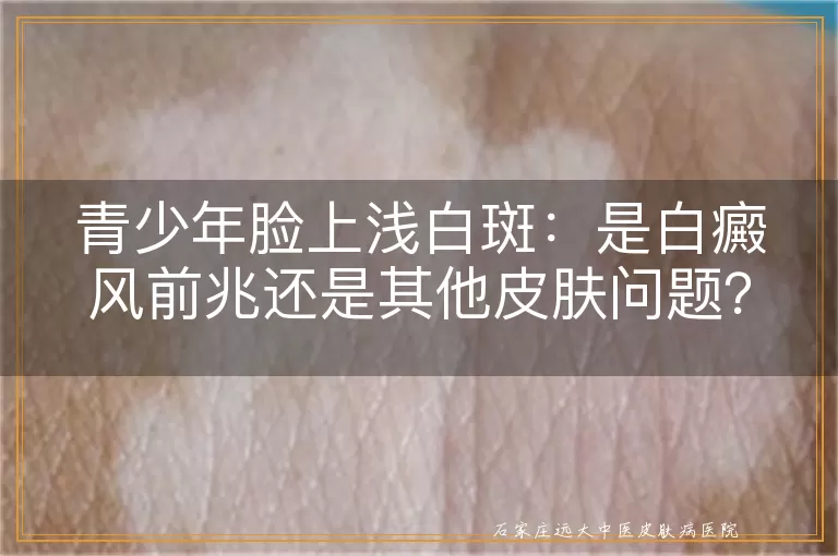 青少年脸上浅白斑：是白癜风前兆还是其他皮肤问题？