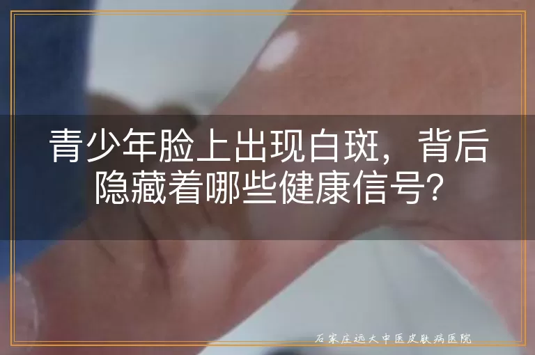 青少年脸上出现白斑，背后隐藏着哪些健康信号？