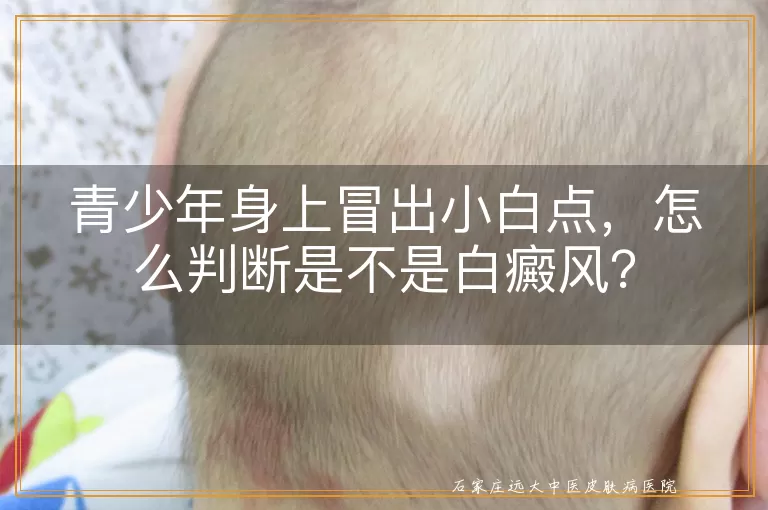 青少年身上冒出小白点，怎么判断是不是白癜风？
