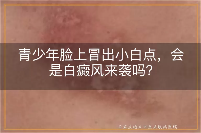 青少年脸上冒出小白点，会是白癜风来袭吗？