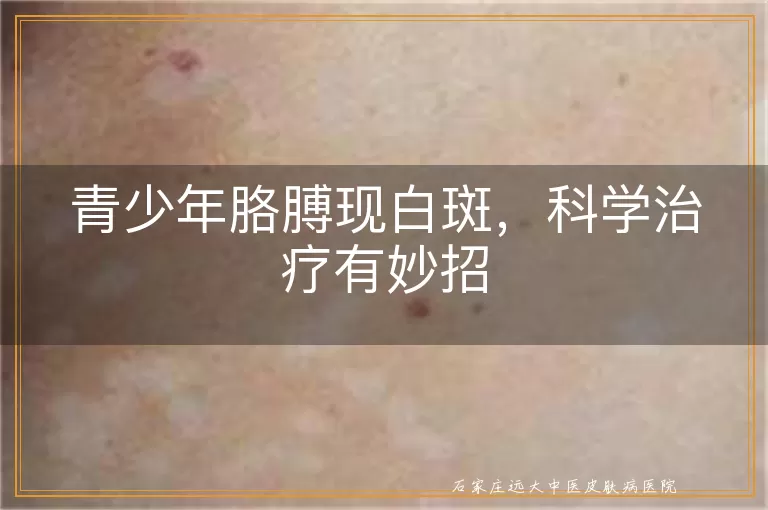 青少年胳膊现白斑，科学治疗有妙招