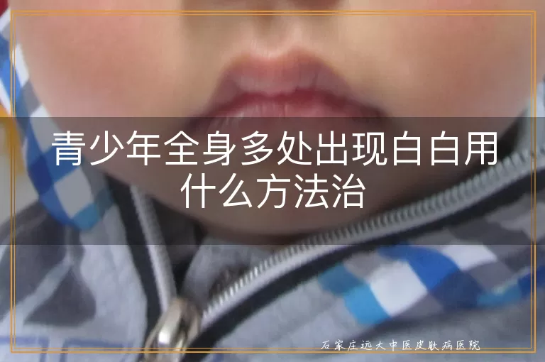 青少年全身多处出现白白用什么方法治