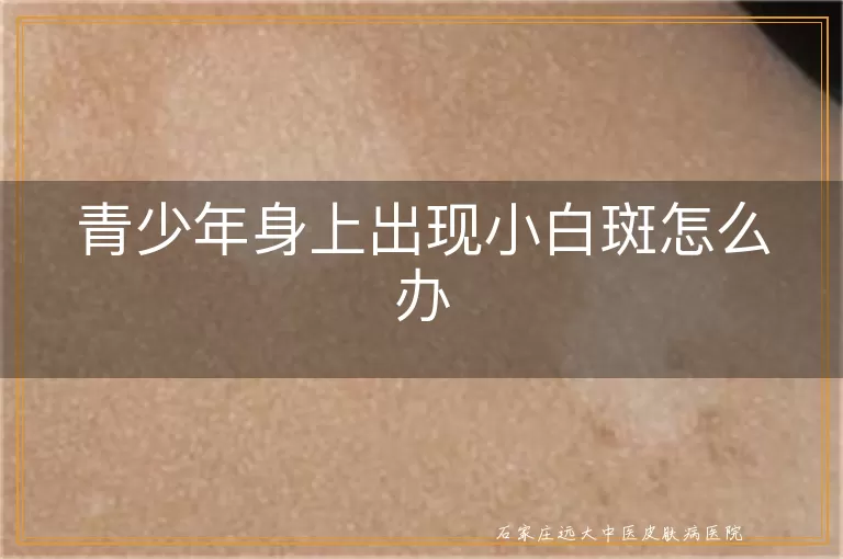 青少年身上出现小白斑怎么办