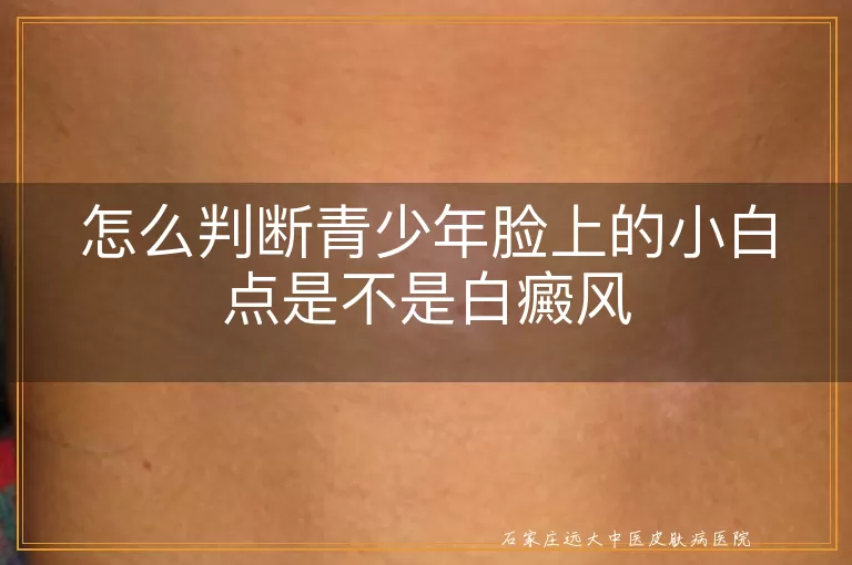 怎么判断青少年脸上的小白点是不是白癜风