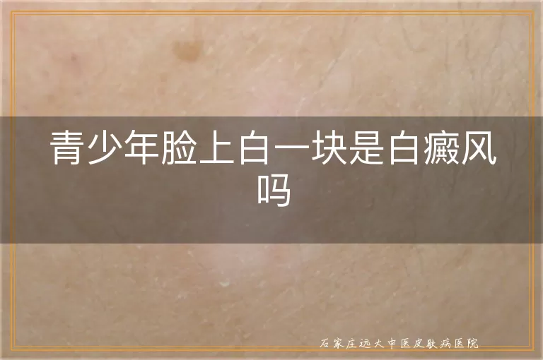 青少年脸上白一块是白癜风吗