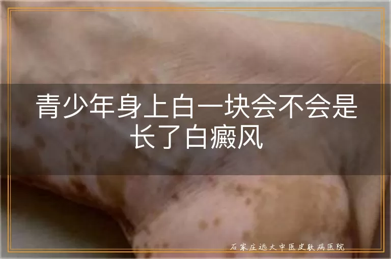 青少年身上白一块会不会是长了白癜风