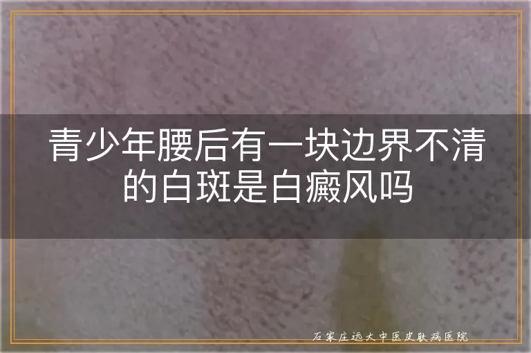 青少年腰后有一块边界不清的白斑是白癜风吗