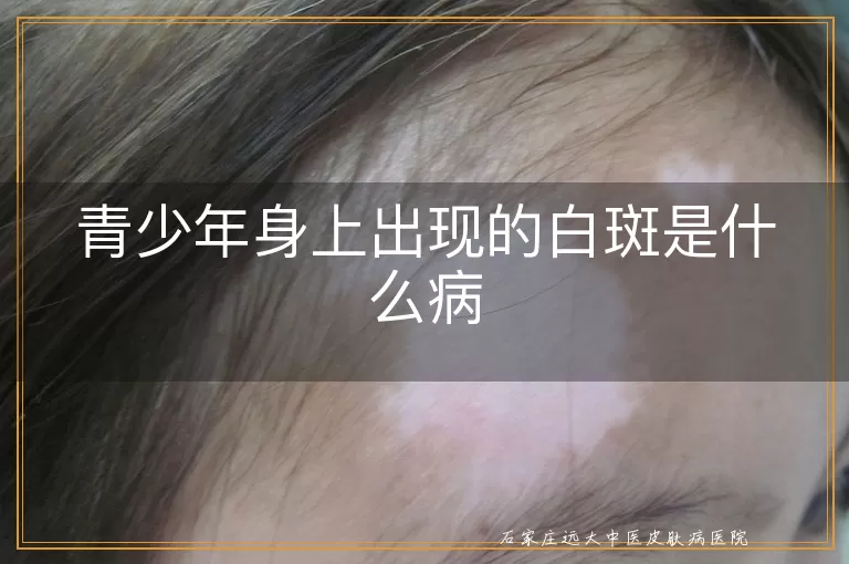 青少年身上出现的白斑是什么病