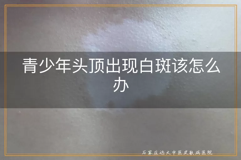 青少年头顶出现白斑该怎么办