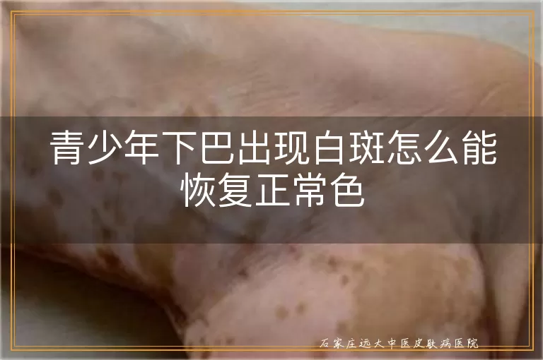 青少年下巴出现白斑怎么能恢复正常色