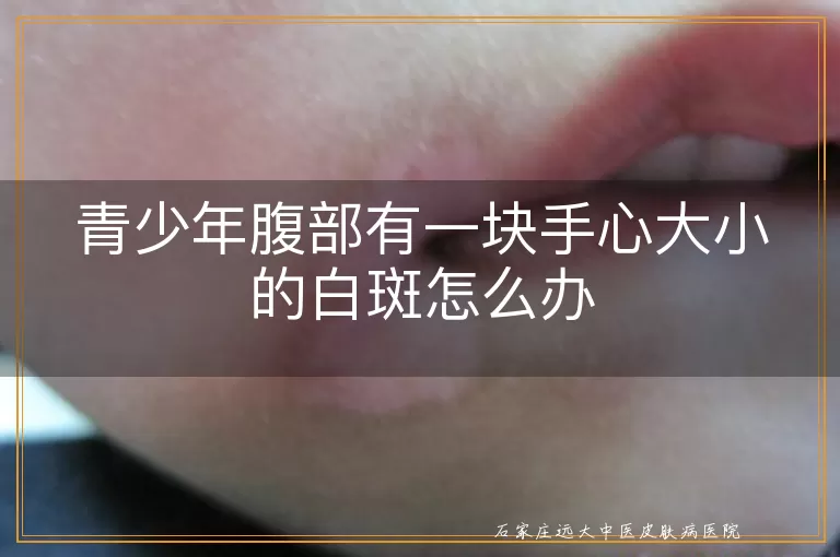青少年腹部有一块手心大小的白斑怎么办