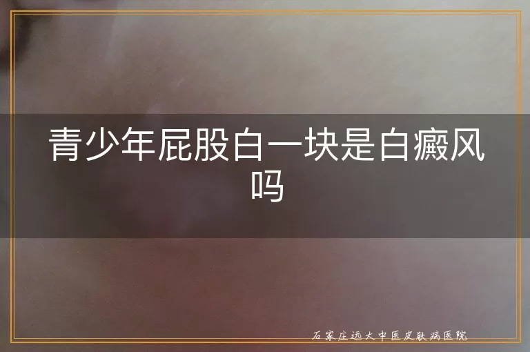 青少年屁股白一块是白癜风吗