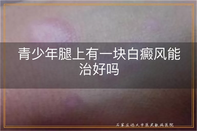 青少年腿上有一块白癜风能治好吗
