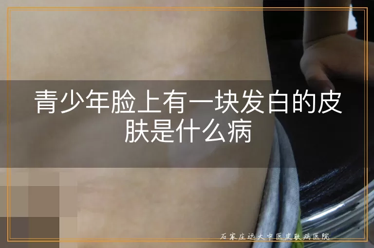青少年脸上有一块发白的皮肤是什么病