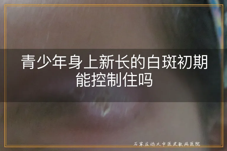 青少年身上新长的白斑初期能控制住吗