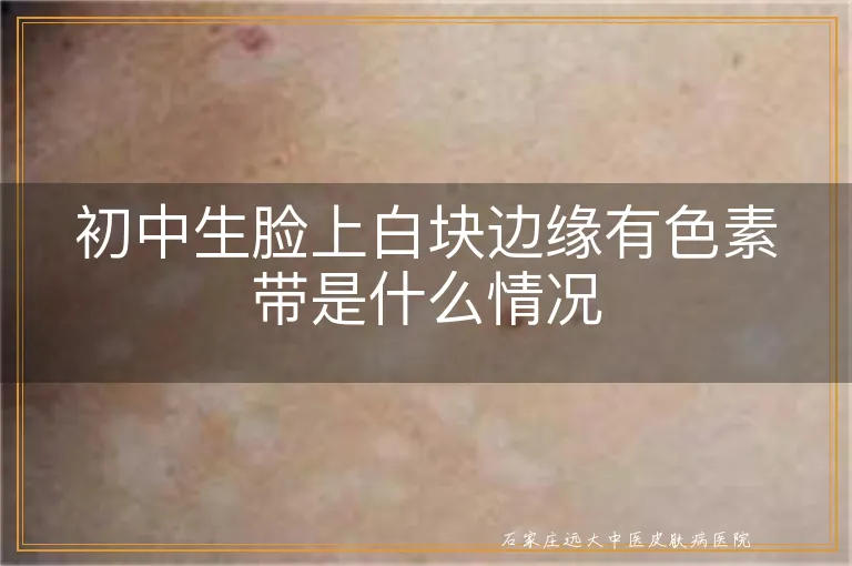 初中生脸上白块边缘有色素带是什么情况