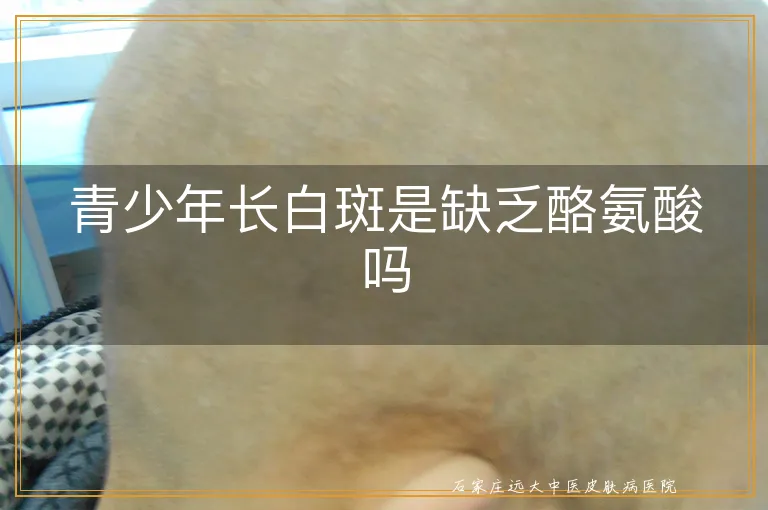 青少年长白斑是缺乏酪氨酸吗