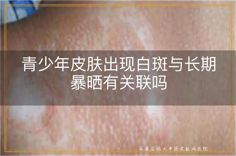 青少年皮肤出现白斑与长期暴晒有关联吗
