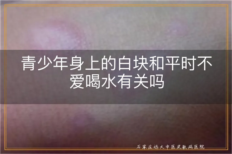 青少年身上的白块和平时不爱喝水有关吗