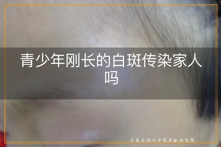 青少年刚长的白斑传染家人吗