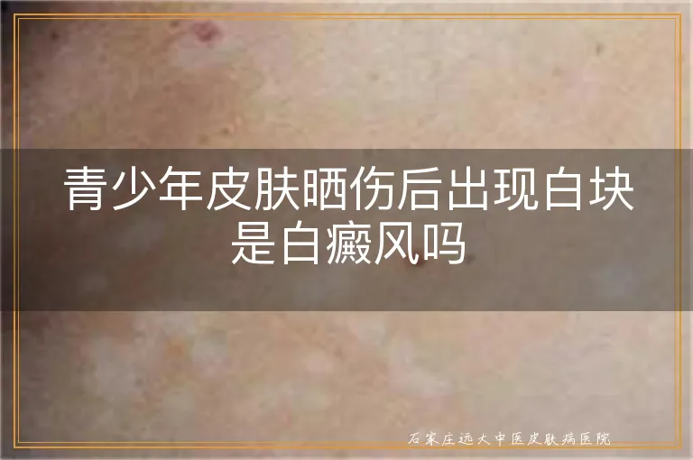 青少年皮肤晒伤后出现白块是白癜风吗
