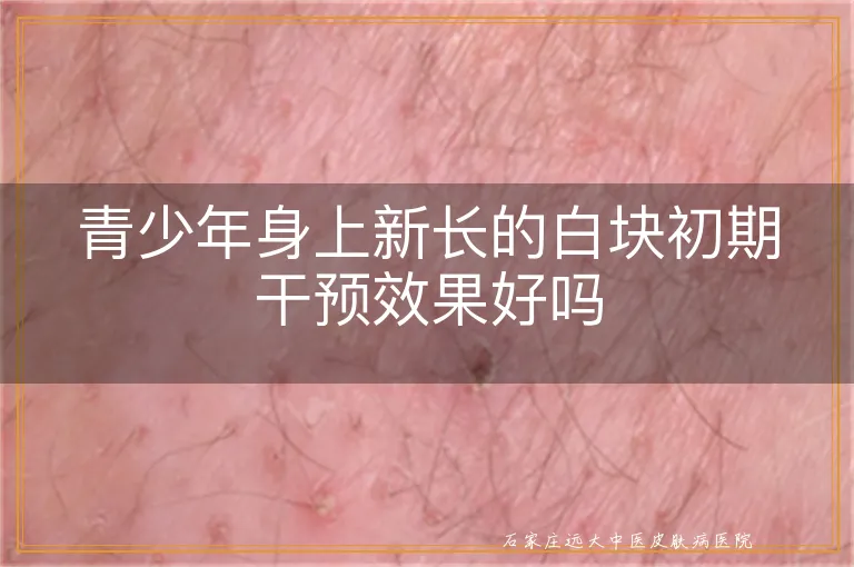 青少年身上新长的白块初期干预效果好吗