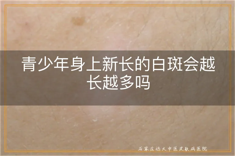 青少年身上新长的白斑会越长越多吗