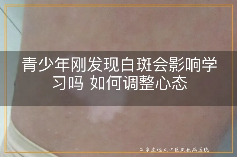青少年刚发现白斑会影响学习吗 如何调整心态