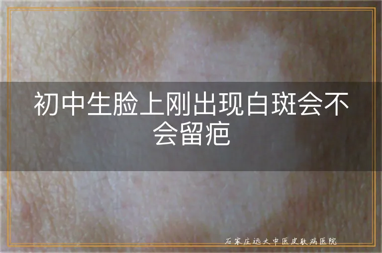 初中生脸上刚出现白斑会不会留疤