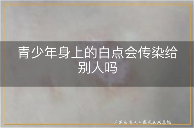 青少年身上的白点会传染给别人吗