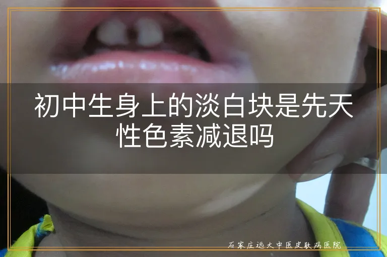初中生身上的淡白块是先天性色素减退吗