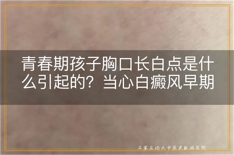 青春期孩子胸口长白点是什么引起的？当心白癜风早期信号