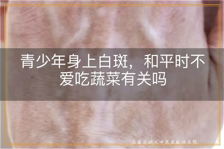 青少年身上白斑，和平时不爱吃蔬菜有关吗