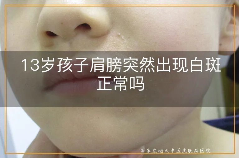 13岁孩子肩膀突然出现白斑正常吗