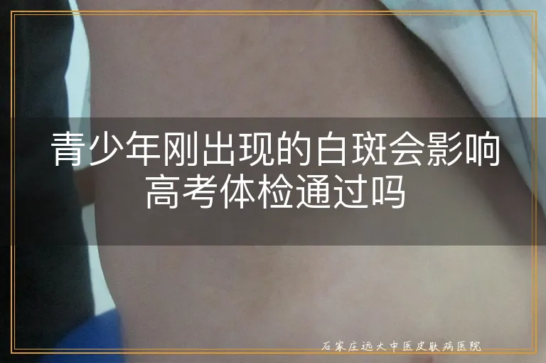 青少年刚出现的白斑会影响高考体检通过吗
