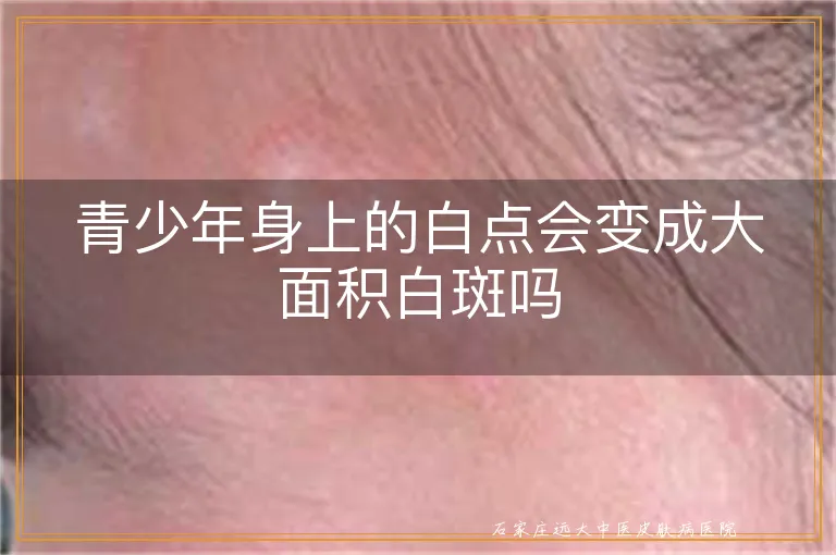 青少年身上的白点会变成大面积白斑吗