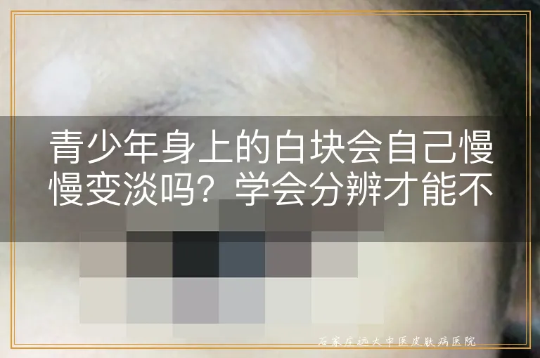 青少年身上的白块会自己慢慢变淡吗?学会分辨才能不耽误