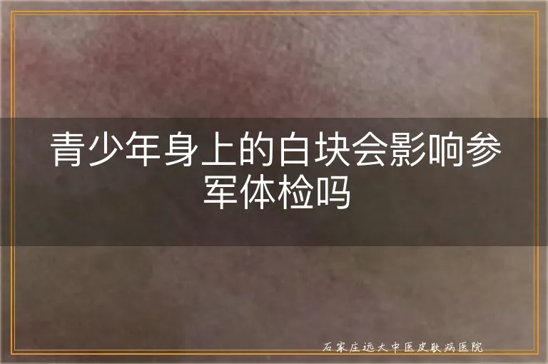 青少年身上的白块会影响参军体检吗