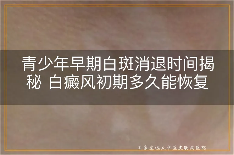 青少年早期白斑消退时间揭秘 白癜风初期多久能恢复