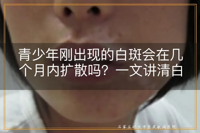 青少年刚出现的白斑会在几个月内扩散吗?一文讲清白斑发展速度